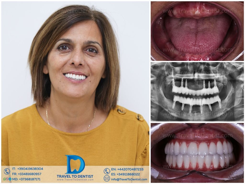 Caso clínico de prótesis dental #5